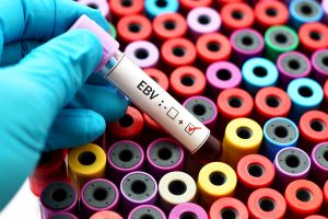 El virus de Epstein-Barr determina la respuesta inmunitaria en la Esclerosis Múltiple